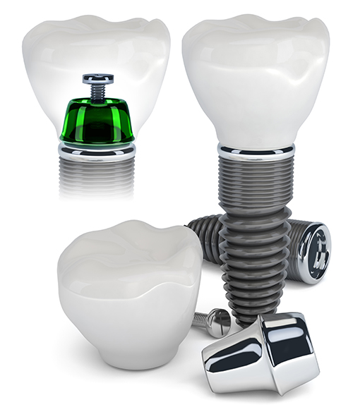 Dental Implants on Huebner Road