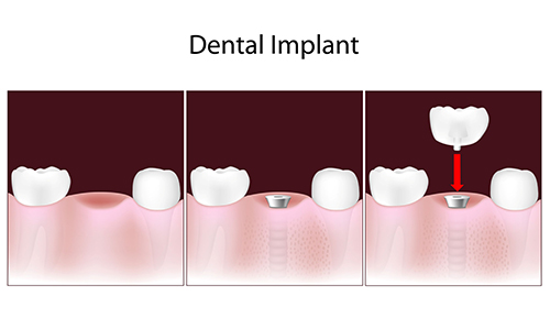 Huebner Road Dental Implants