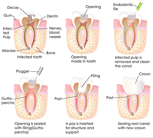 Huebner Road Root Canal